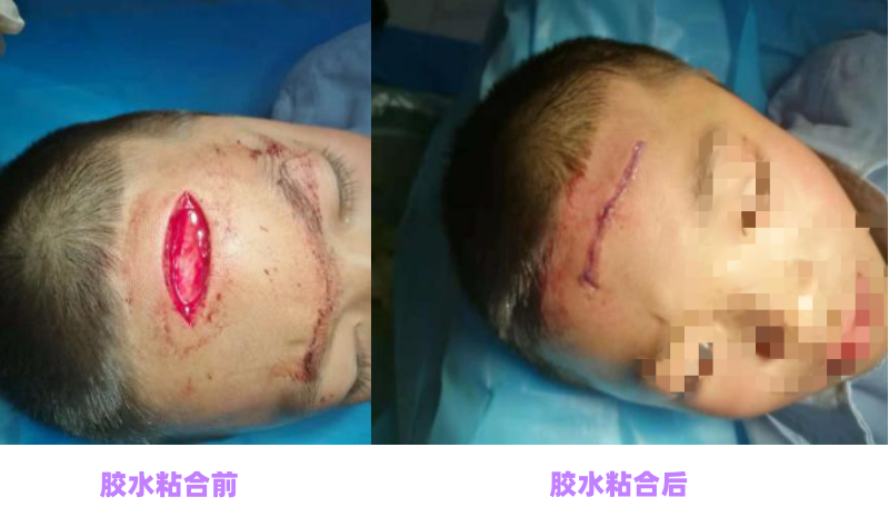 医用胶水粘合儿童额头伤口前后对比图.png