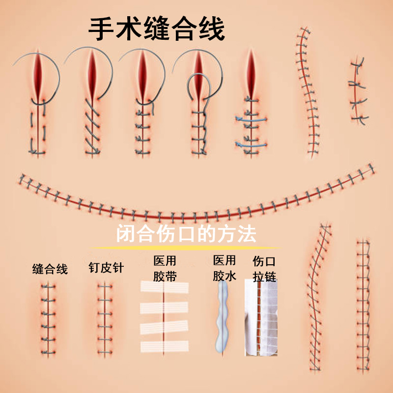 伤口闭合方式多，如何选择有讲究
