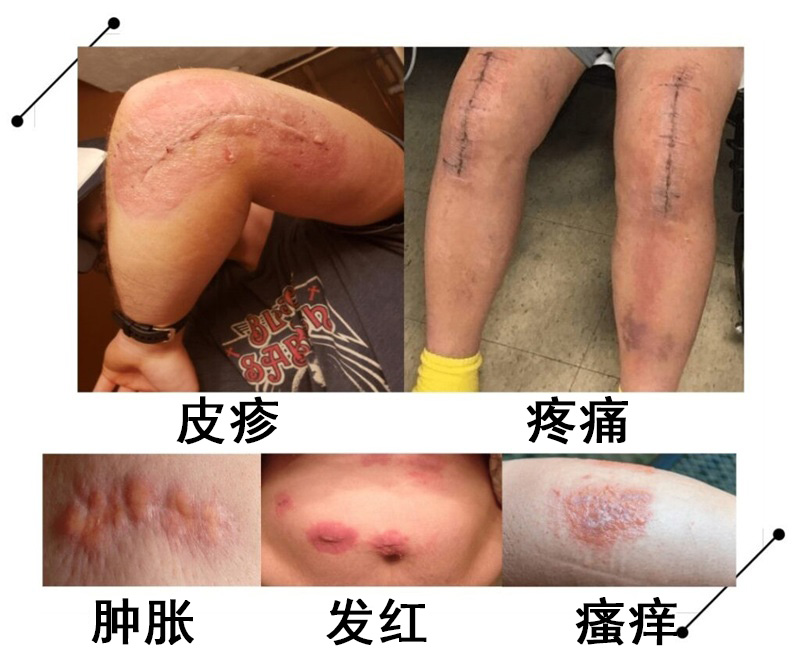 pictures-of-allergic-reaction-to-surgical-glue-min-1024x835.jpg