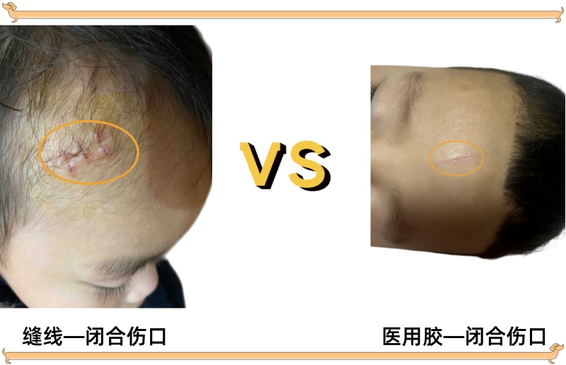 缝线VS医用胶闭合伤口的效果.jpg