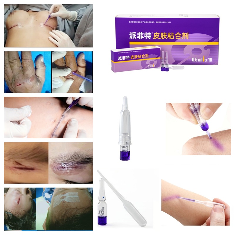 派菲特医用胶应用(1).jpg