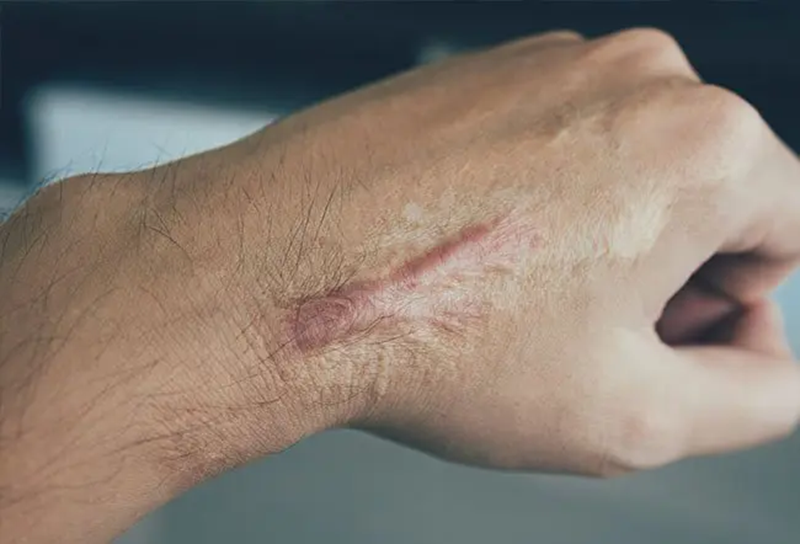 疤痕伤口图片1.png